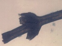 Бамбуковые волосы (trichorrexis invaginata)