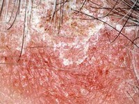 Себорейный дерматит: от диагностики к лечению