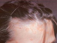 Псориаз волосистой части головы (чешуйчатый лишай)