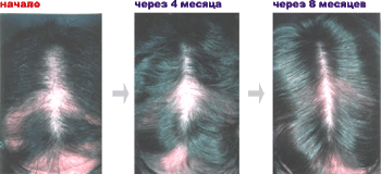 ВОССТАНОВЛЕНИЕ РОСТА ВОЛОС У ЖЕНЩИН